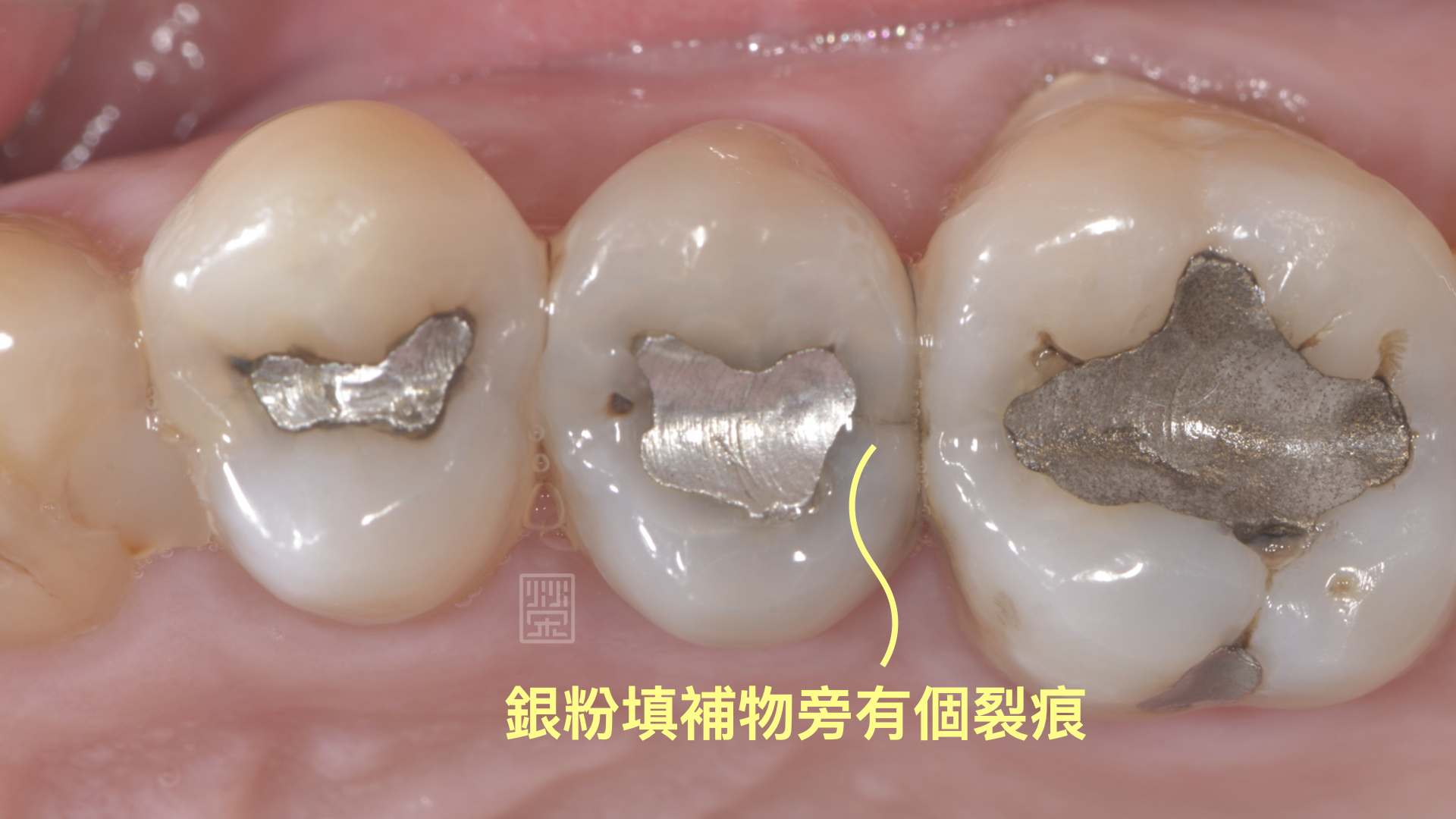 牙齒旁邊有裂痕