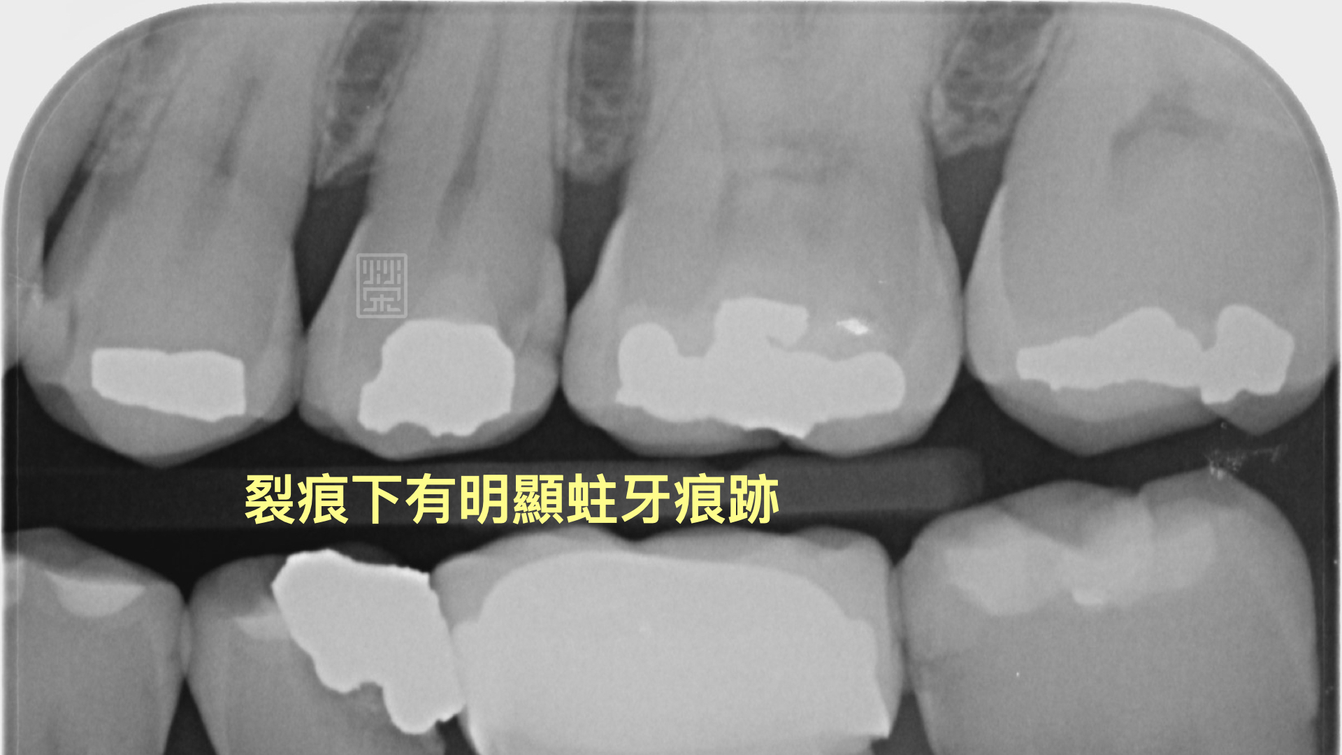 裂痕相對位置下的Ｘ光片，可以明顯發現蛀牙