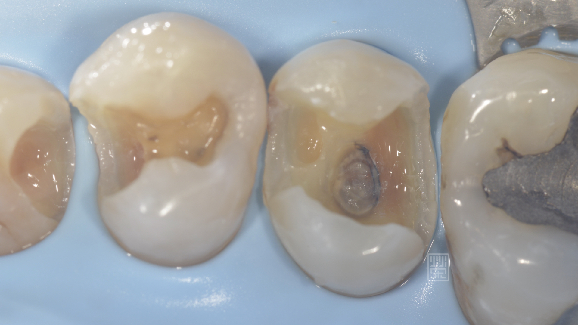 當把填補物與蛀牙清除後，發現蛀牙比預想的還大