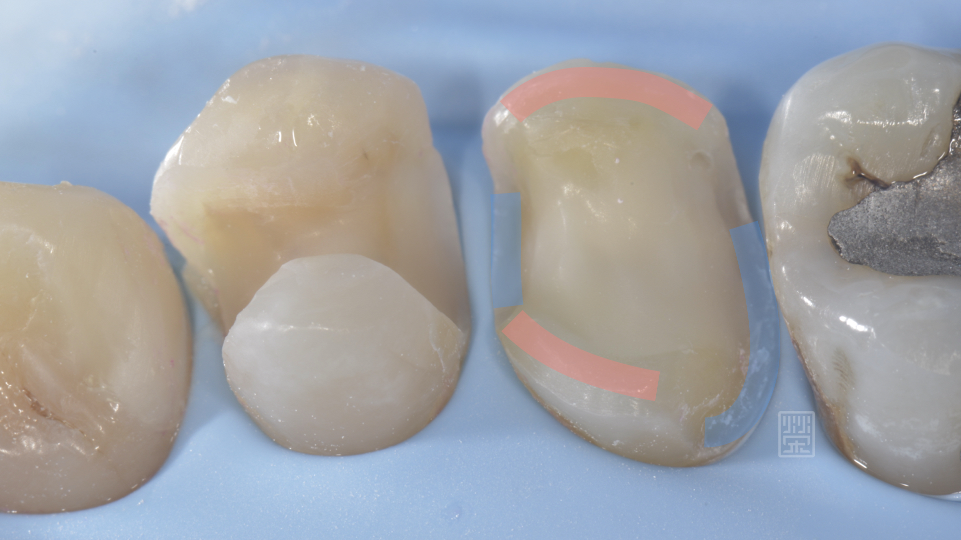 紅色是齒質，只做1mm空間修復，藍色部分是蛀牙至牙齦處，修磨至牙齦處