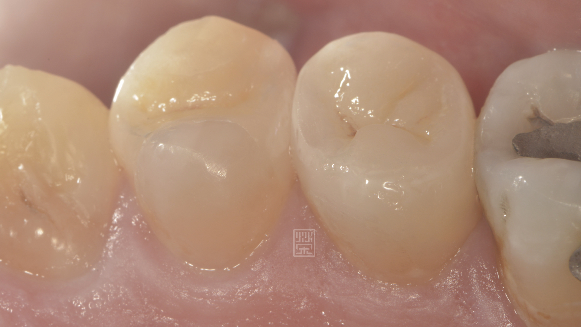 利用全瓷嵌體完整修復，恢復功能與美觀