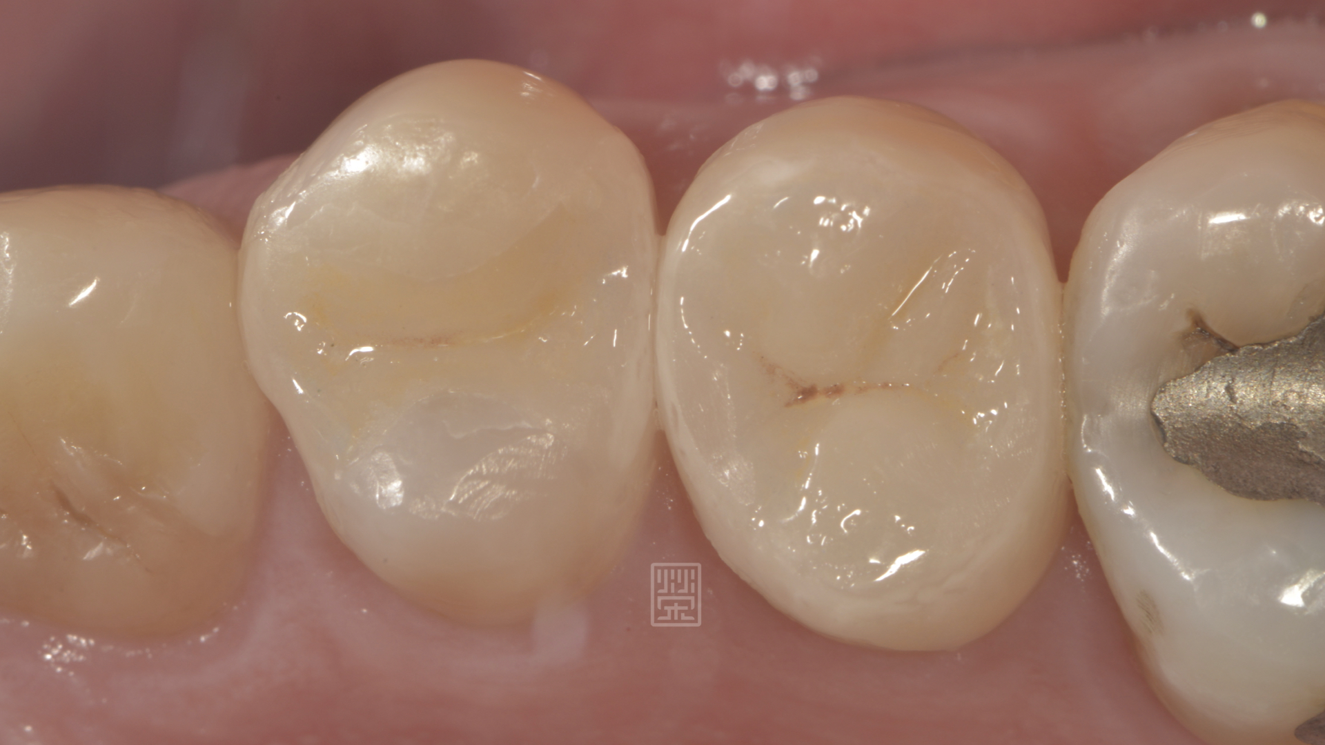 利用全瓷嵌體完整修復，恢復功能與美觀