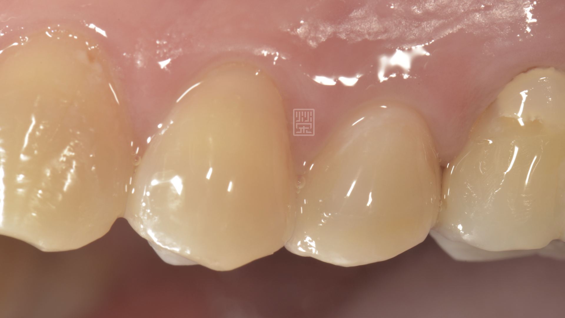 全瓷嵌體完整修復，恢復功能與美觀，頰側顏色與牙齒協調自然