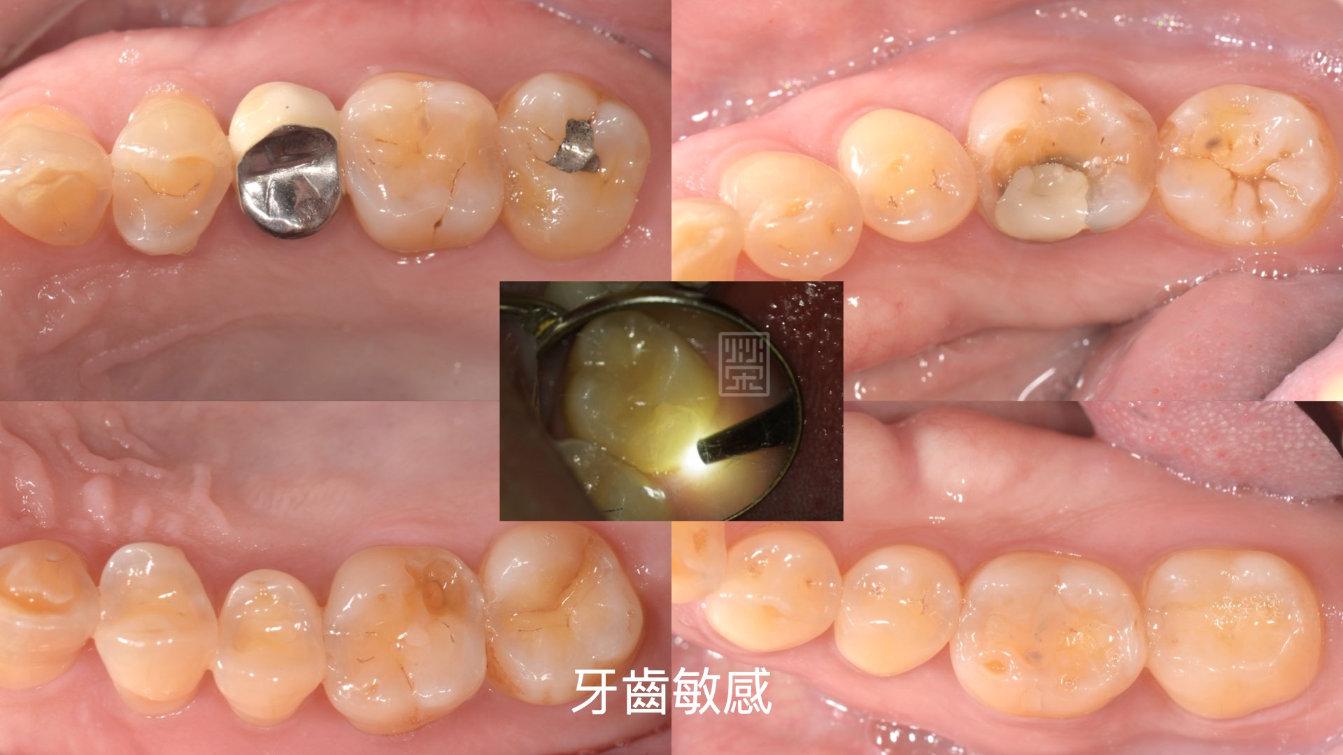 後牙多處牙磨至牙釉質穿透,牙本質露出