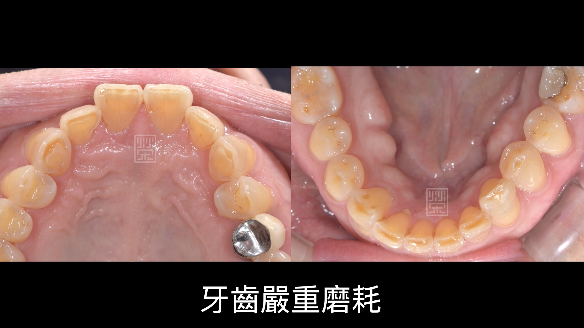 前牙切端牙釉質都穿透,中間牙本質露出來