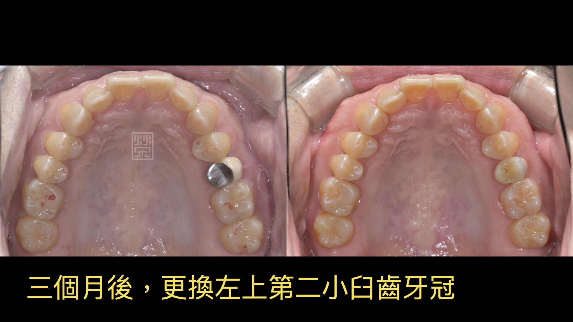 等待咬合穩定後,更換牙套