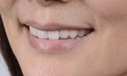 牙齒顏色變黃斑駁，排列不整齊---全瓷冠治療