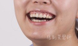 假牙歪斜，牙齦萎縮，牙齦變黑---全瓷冠合併牙齦整形術