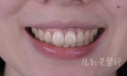 根管治療齒色變暗---全瓷冠合併齒內美白