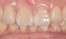 磨牙牙齒變短---全瓷貼片修復