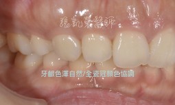 貼片變黑並且脫落---全瓷冠併齒內美白