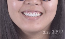 根管治療後牙齒變黃---全瓷冠合併齒內美白