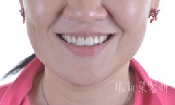 牙齒大小不均---矯正後合併全瓷冠貼片治療