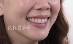 笑齦太多牙齒內縮---全瓷貼片合併牙齦整形術