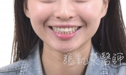 矯正微笑重建---全瓷冠合併全口美白