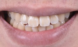 外傷門牙斷裂---微創貼片修復