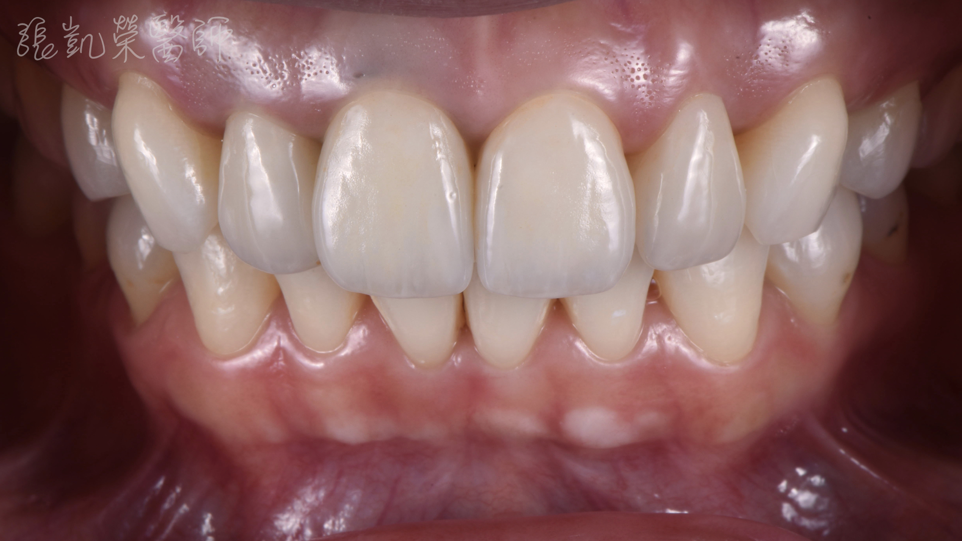 全瓷冠貼片完成