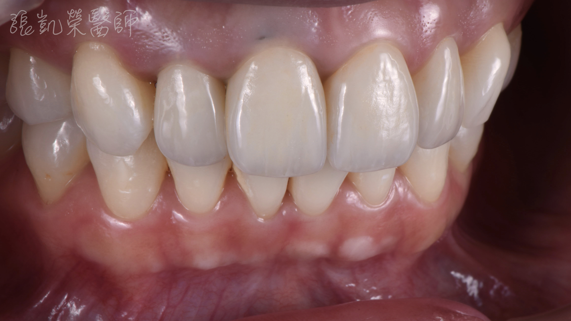 全瓷冠貼片完成