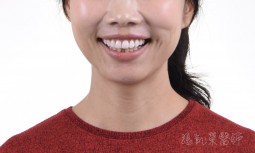 牙齒有點凸，顏色不好看---全瓷貼片矯正排列與增進亮白