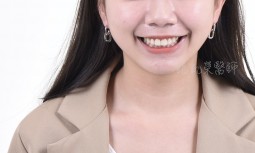 牙齒大小不均，齒色變黃------美白、全瓷冠、貼片、牙齦整形術修復