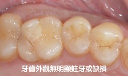 我咬起來會酸痛，無法用力咬-----利用全瓷嵌體修復牙齒斷裂痕