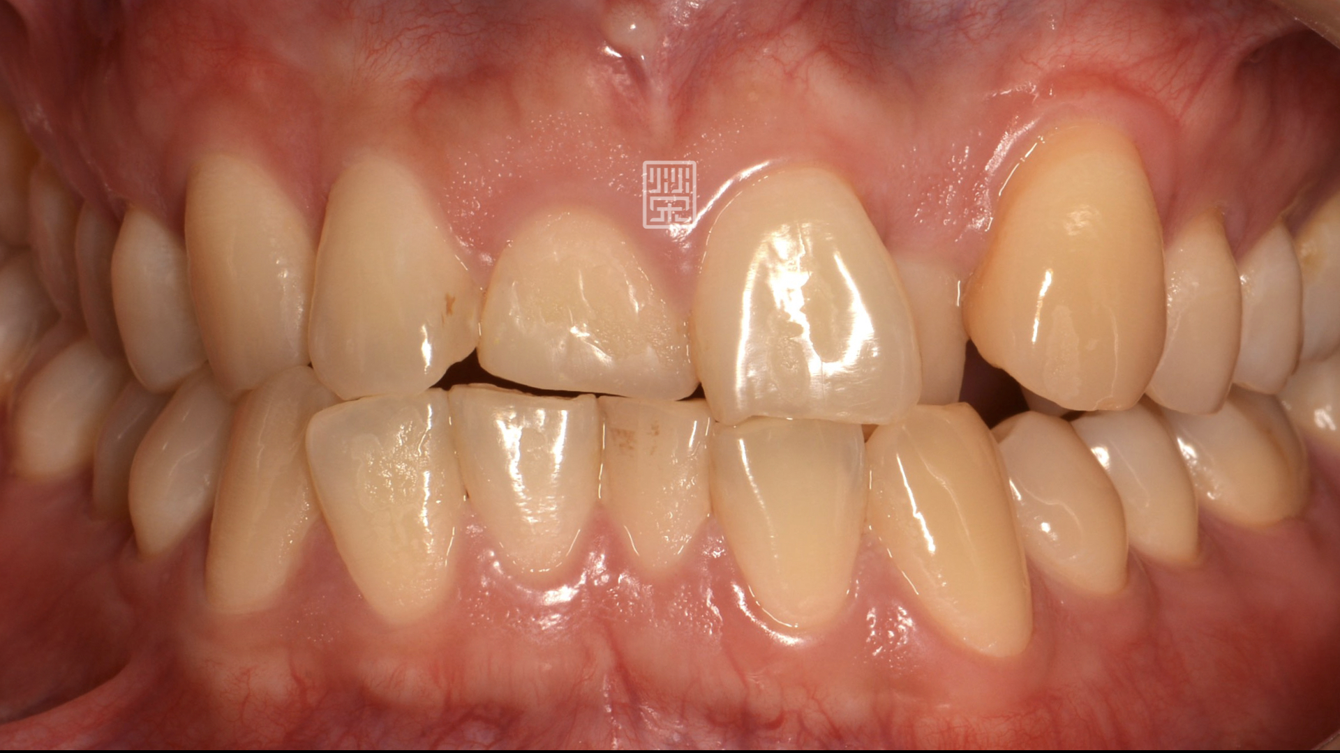 牙齒不整疾並且牙齒磨耗