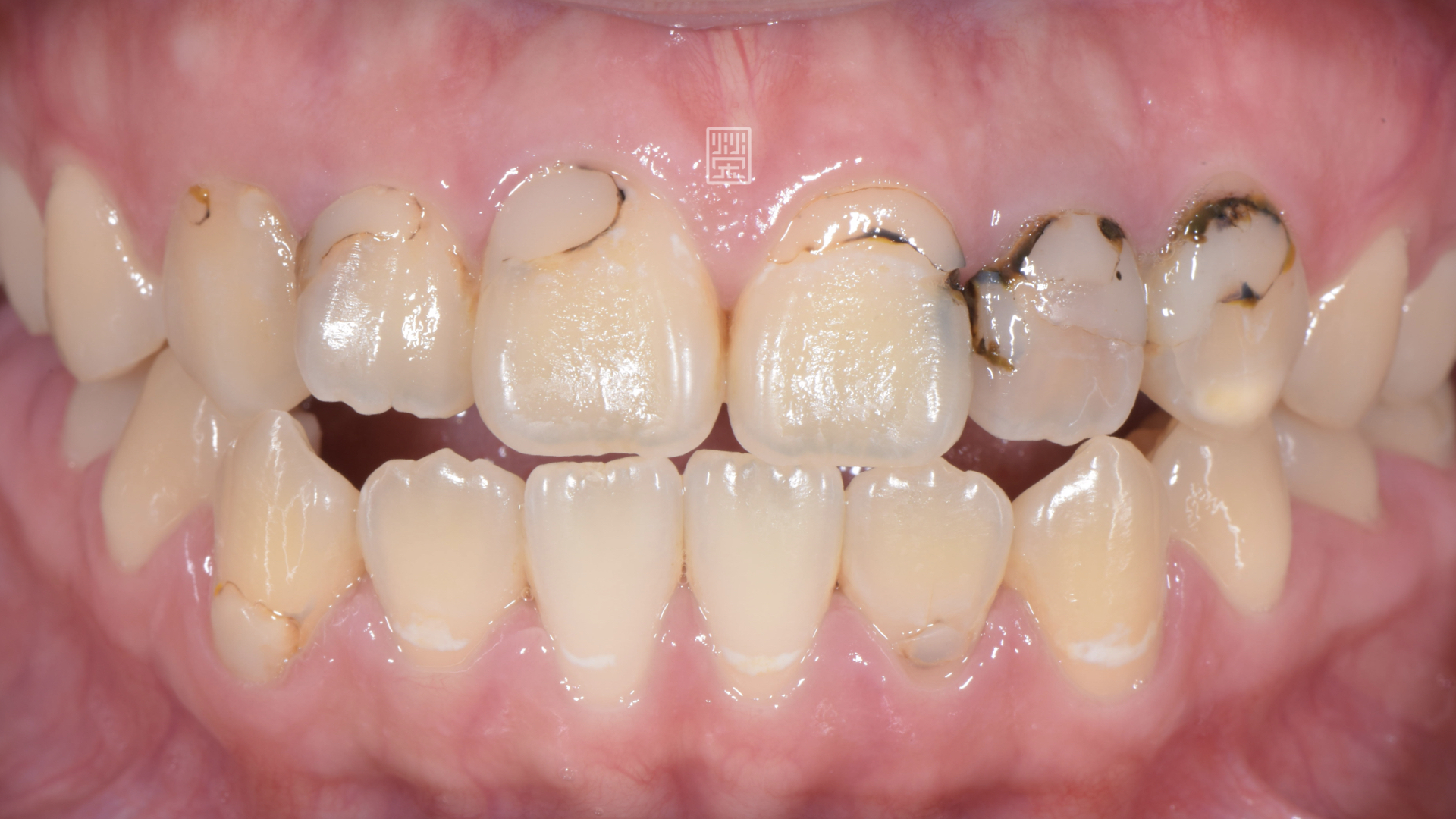 樹脂顏色變色，並且有蛀牙