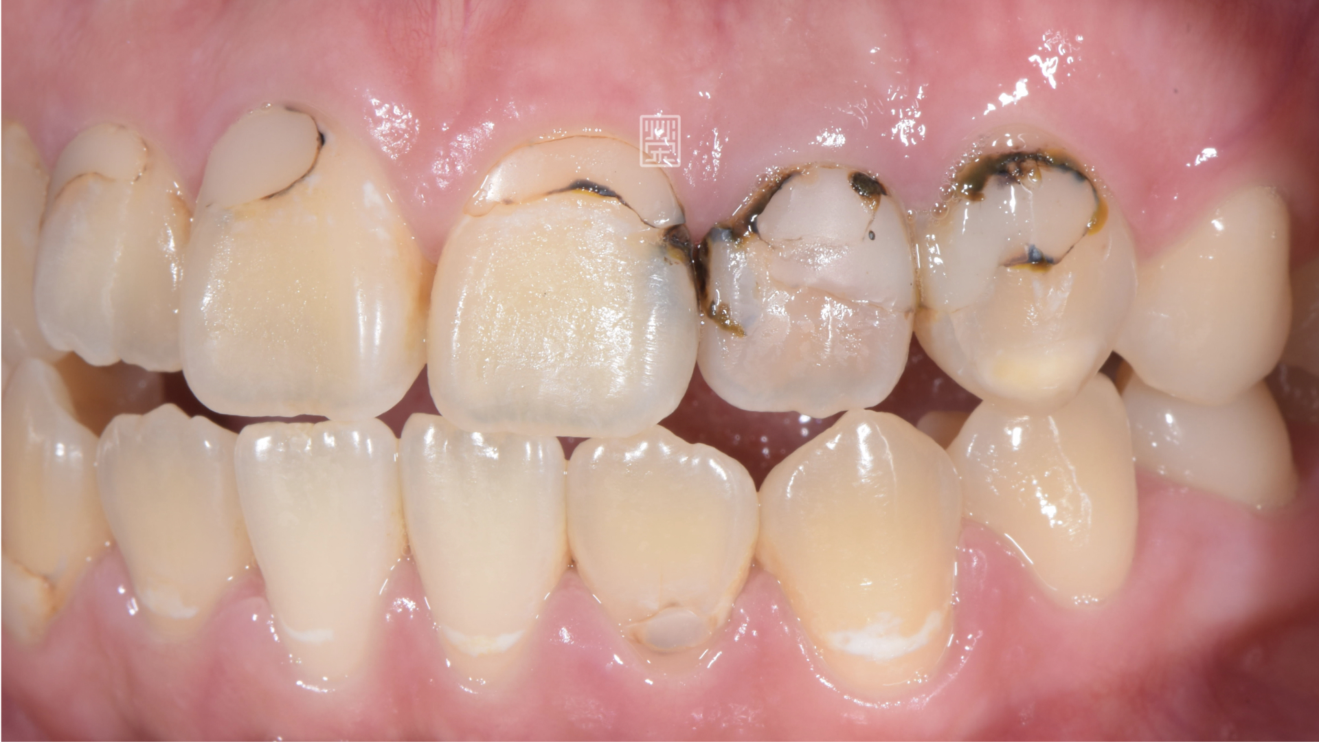 側門牙蛀牙嚴重