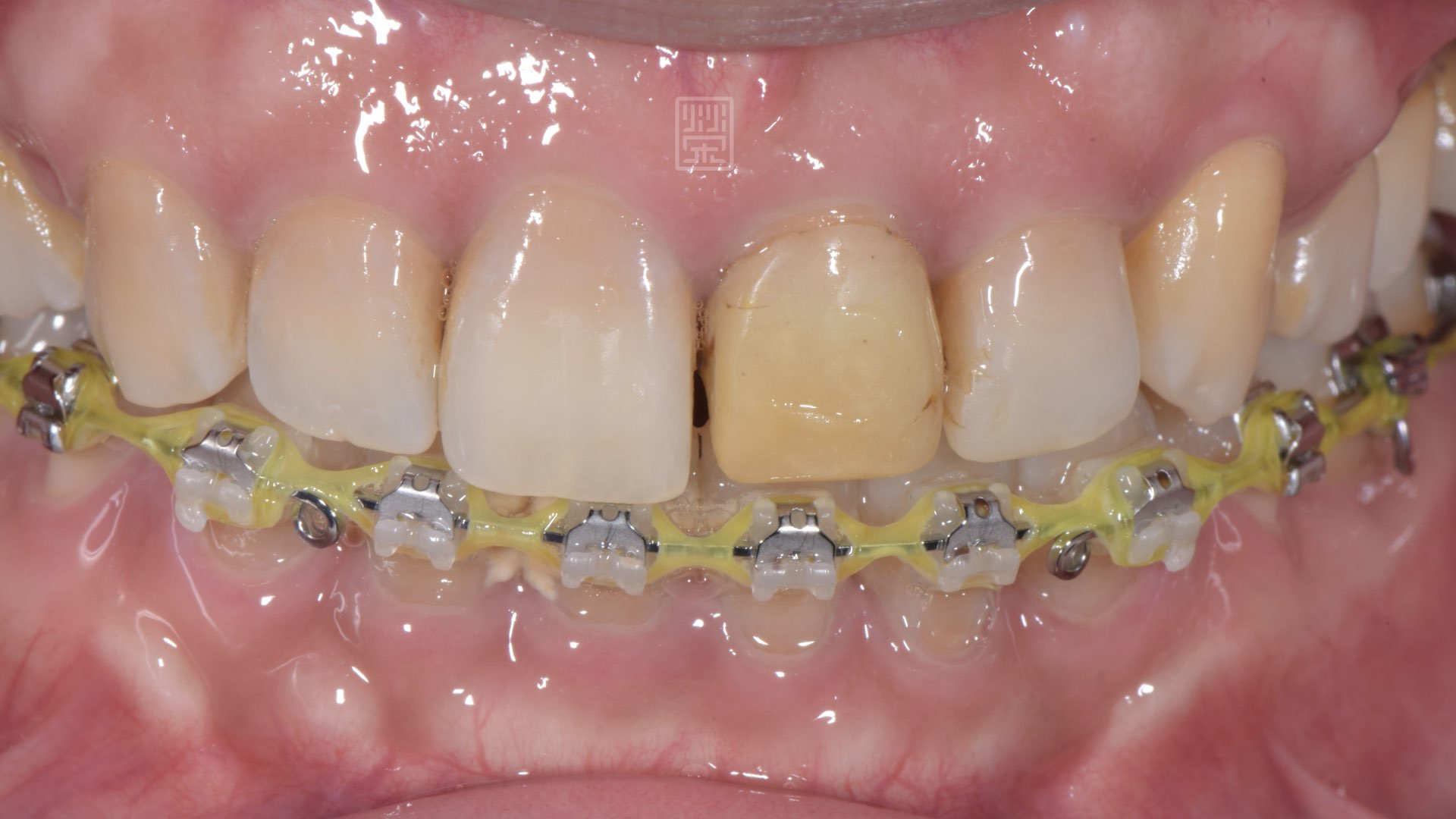 矯正後，牙齒已經排整齊，並將牙齒拉出
