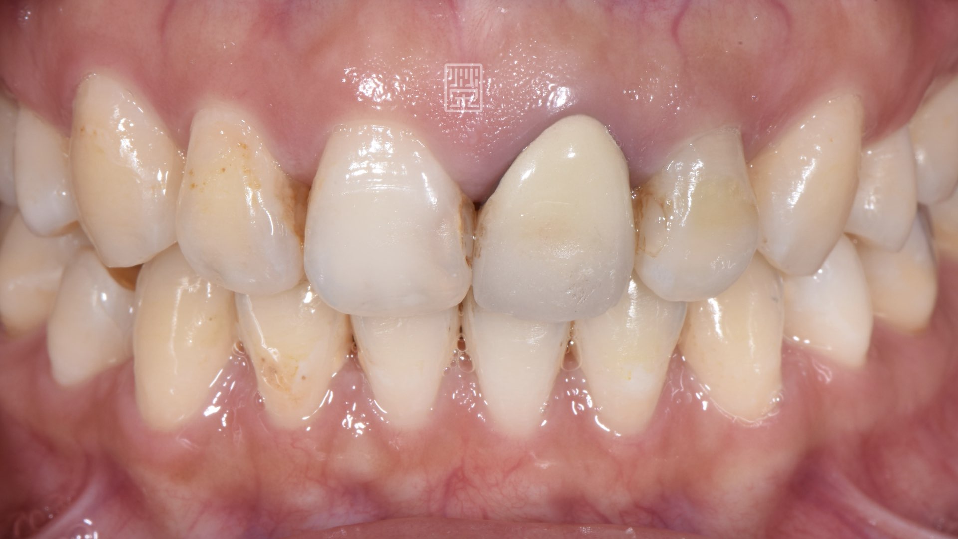 樹脂變色、蛀牙、全瓷冠變色