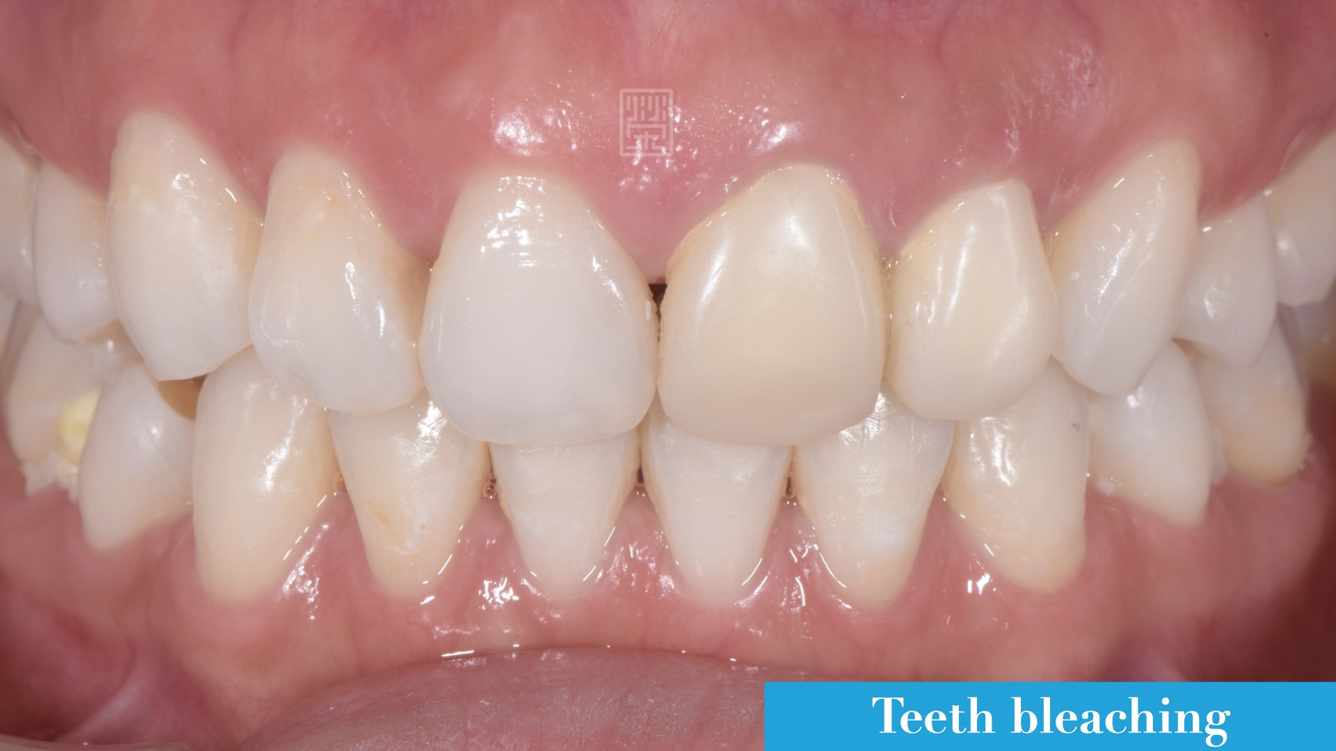 美白後，利用美學樹脂修復