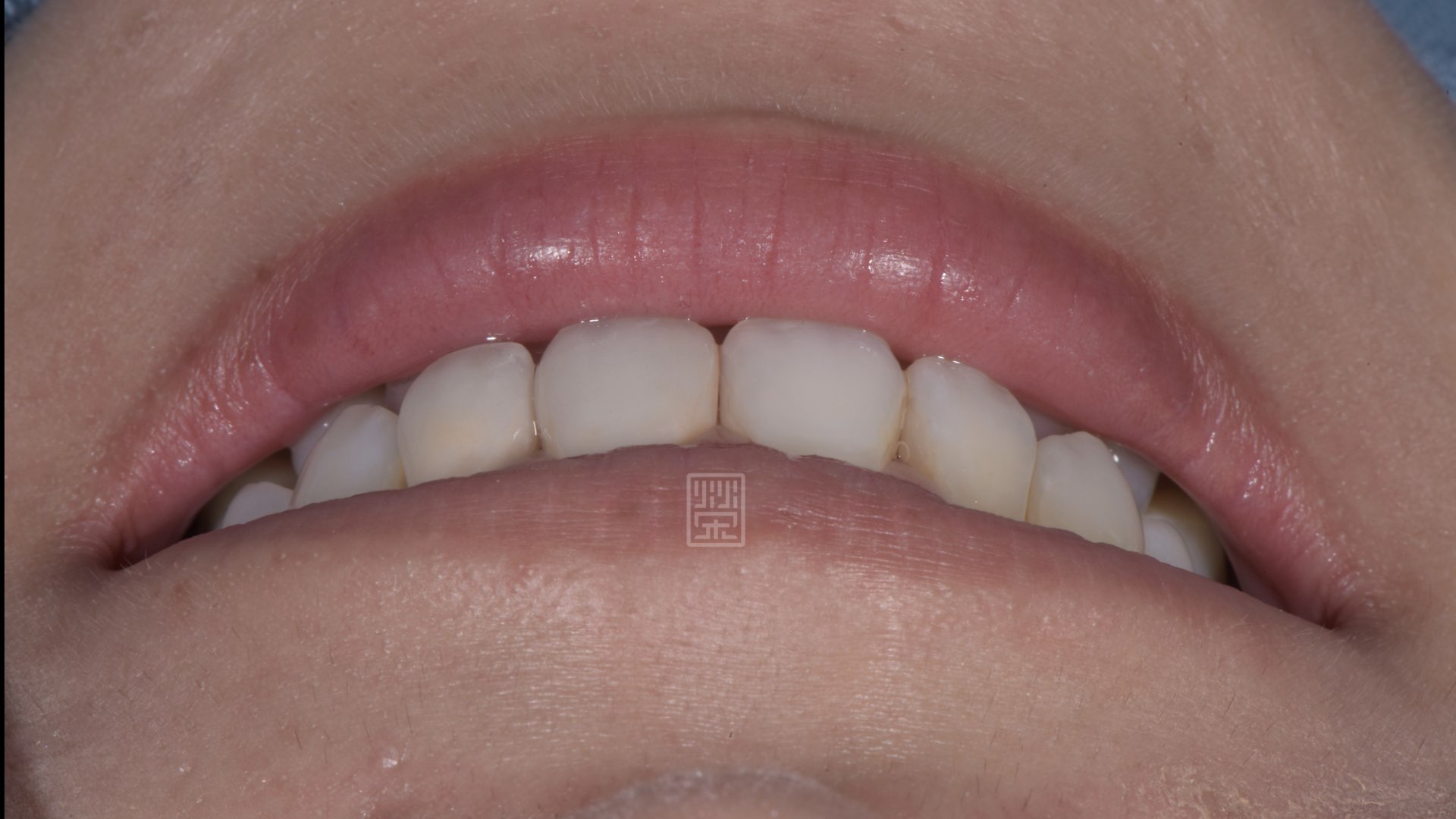 12點鐘完美對稱