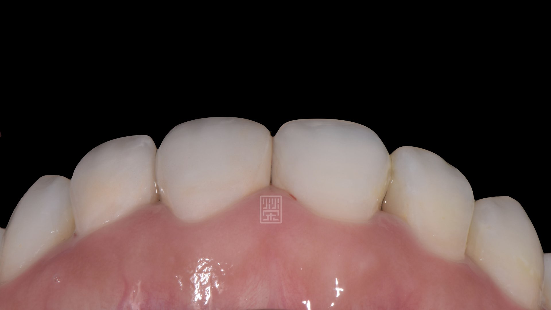 牙齦、牙齒、笑容和諧呈現