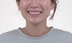 牙齒黑黑的，笑起來不好看——美學樹脂、美白、全瓷冠修復