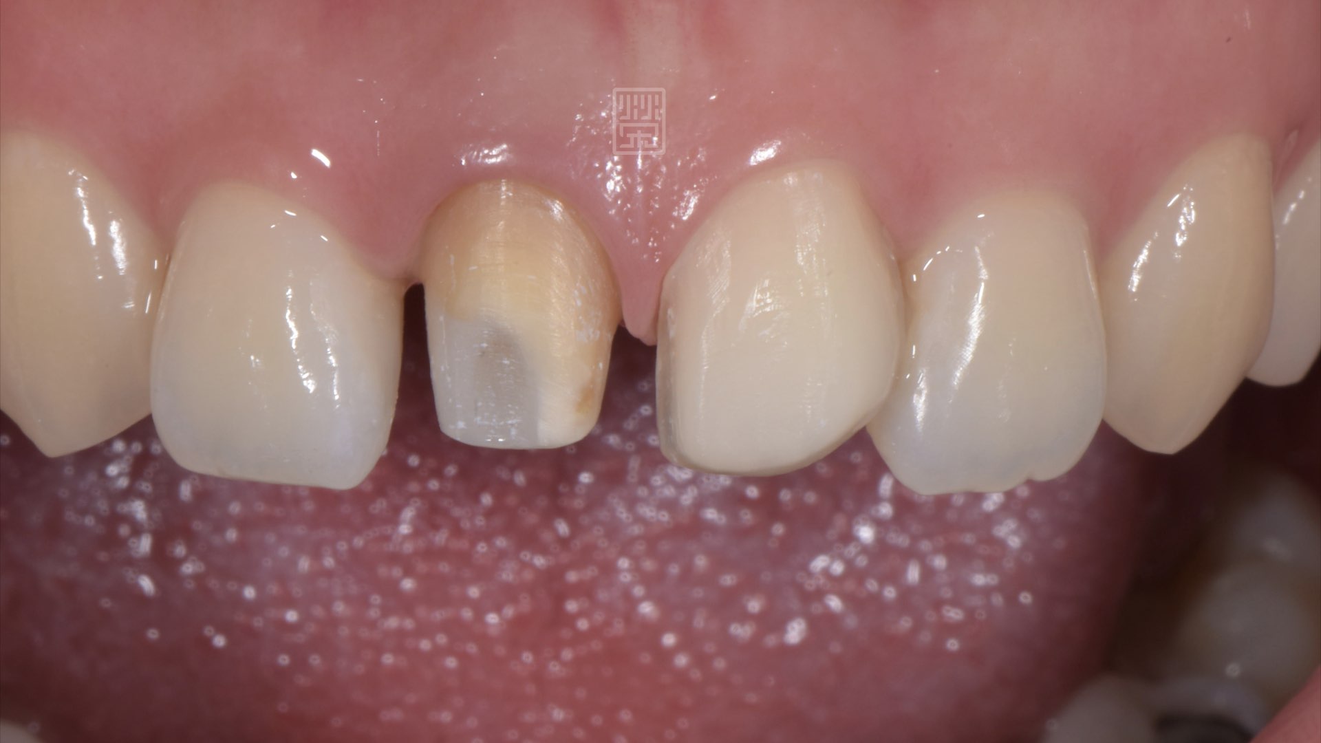 全瓷冠與貼片修磨