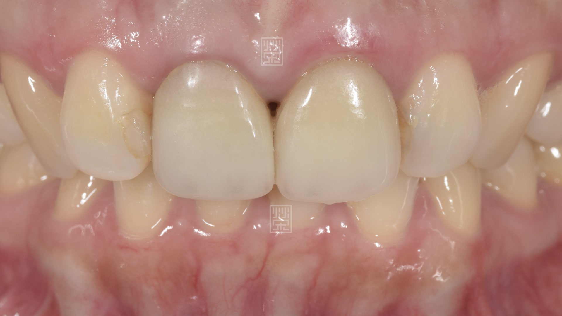 全瓷冠變色，牙齦萎縮