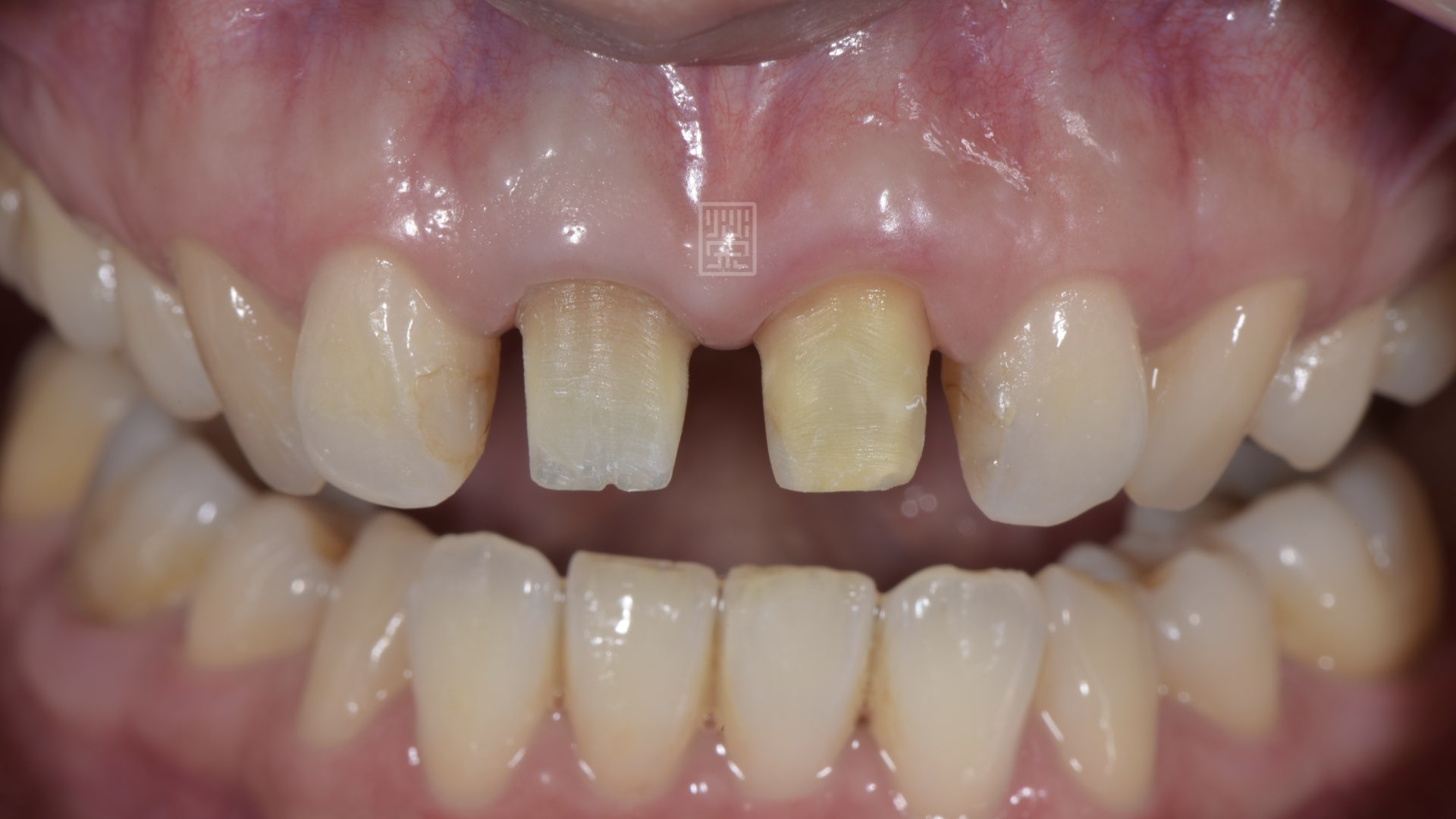 牙齦穩定後，發現門牙中間的牙齦萎縮