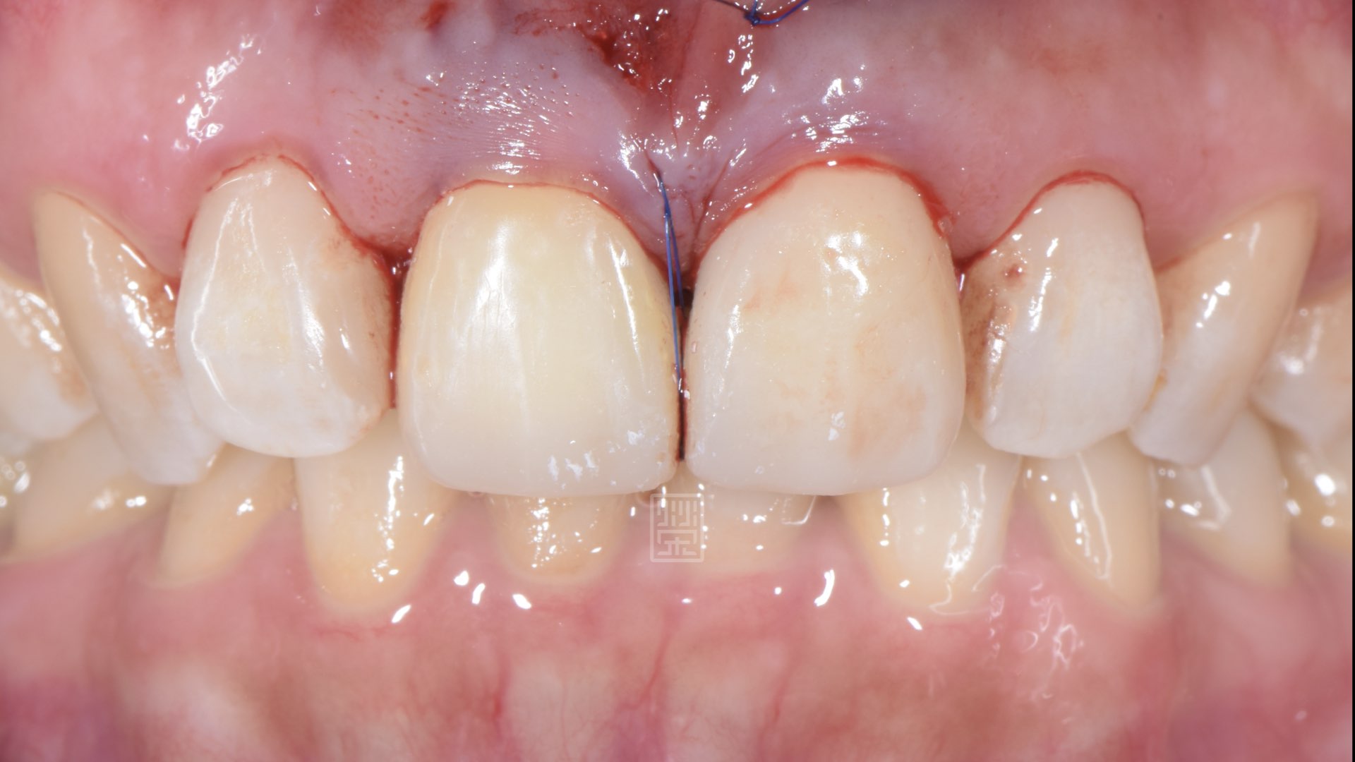 牙齦手術，將黑三角縫填補