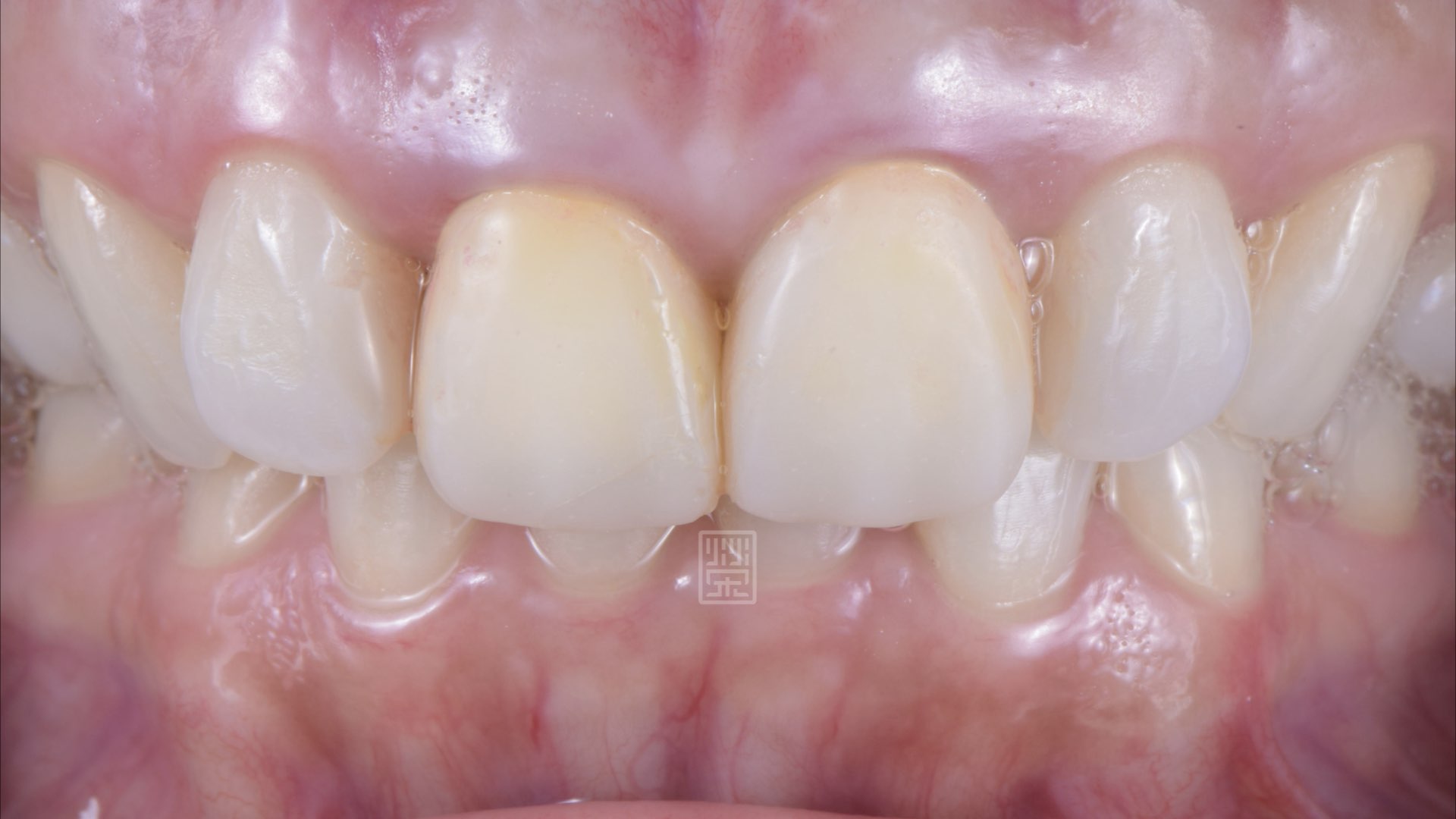 六週後牙齦穩定