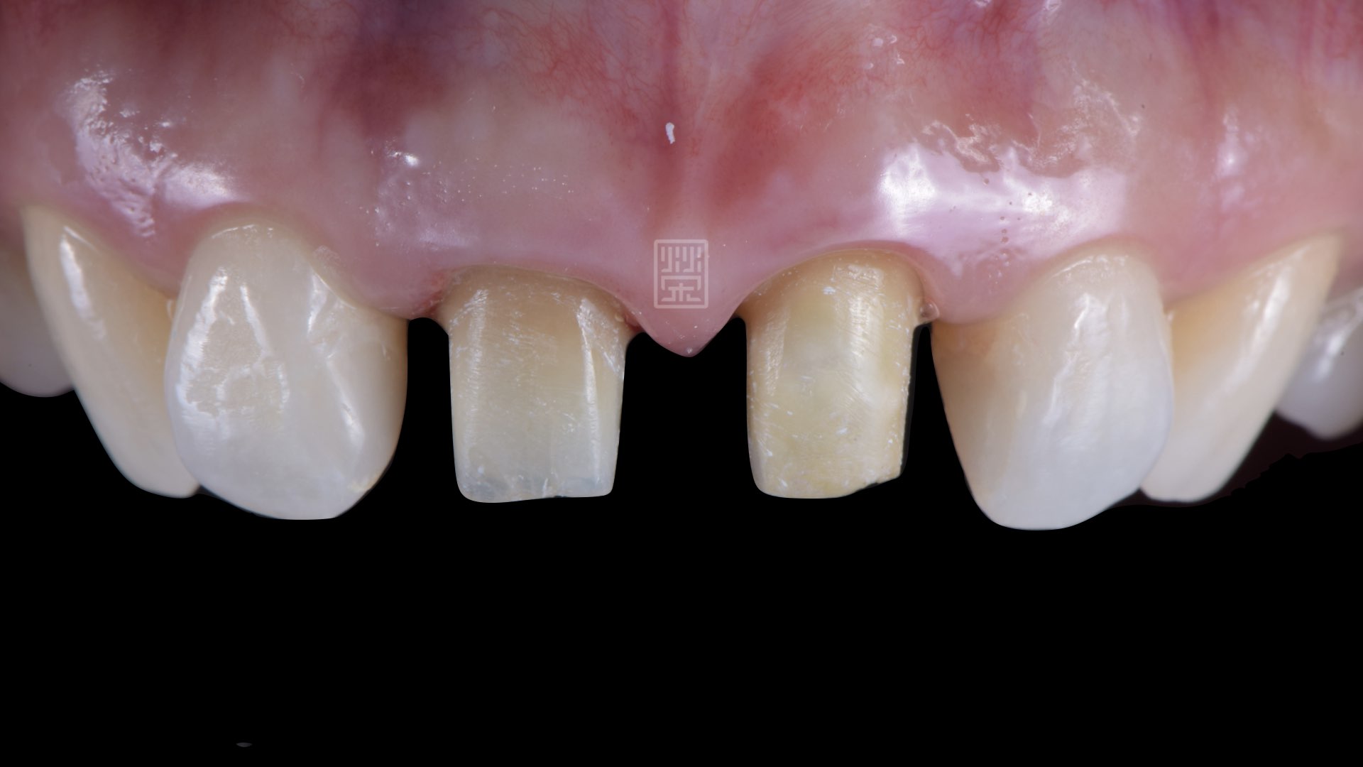 六週後牙齦穩定