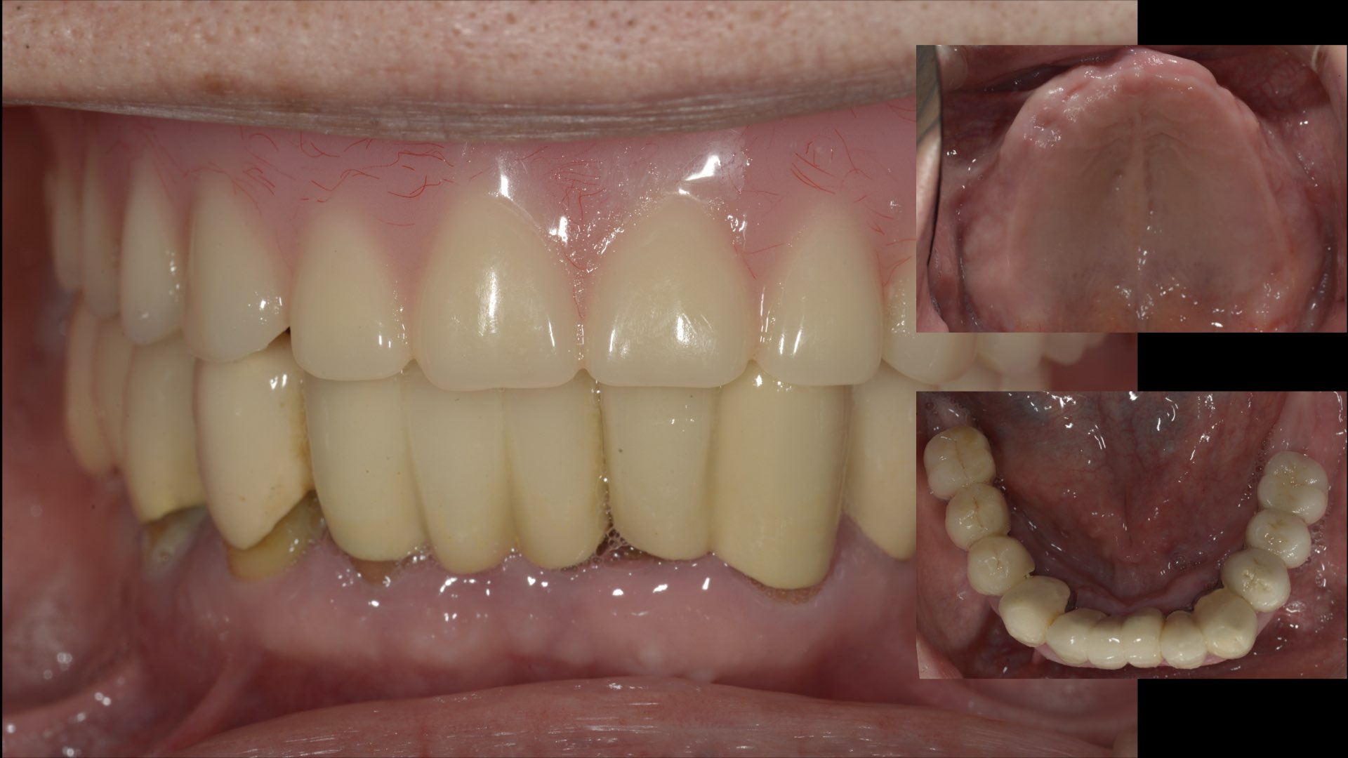 上顎全口義齒併下顎局部活動義齒