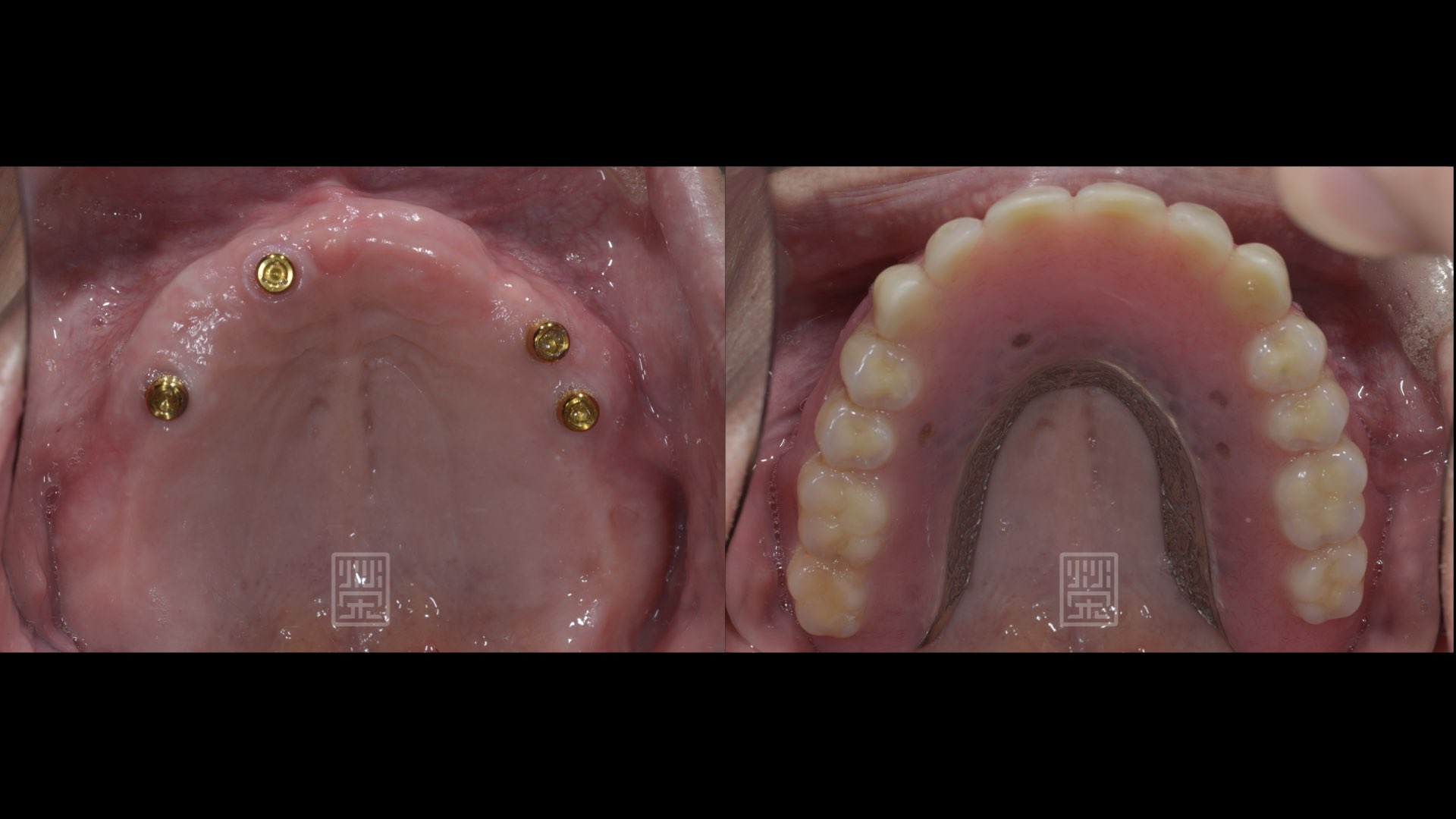 上顎增加四顆植牙，活動義齒顎側挖空後，仍可有穩定的功能與美觀