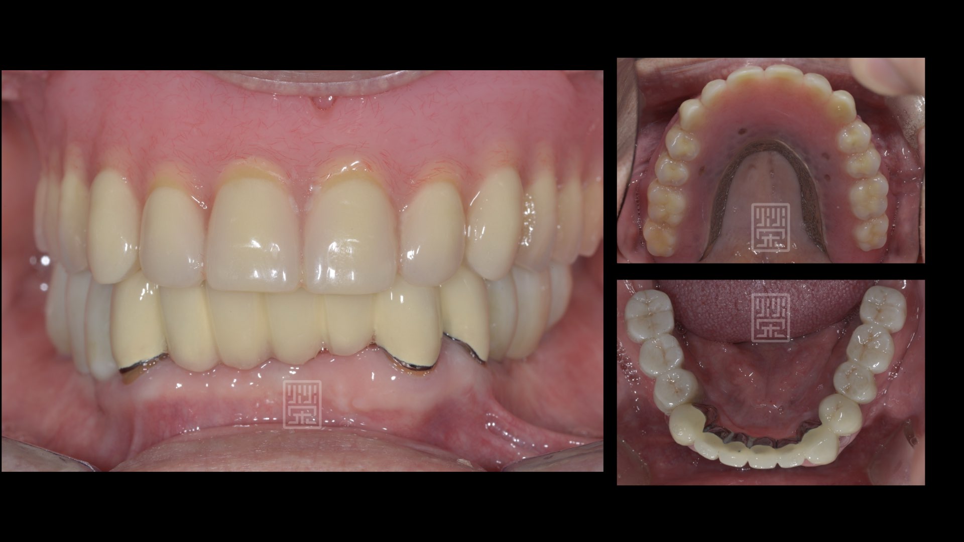 下顎利用局部固定義齒與植牙固定義齒修復