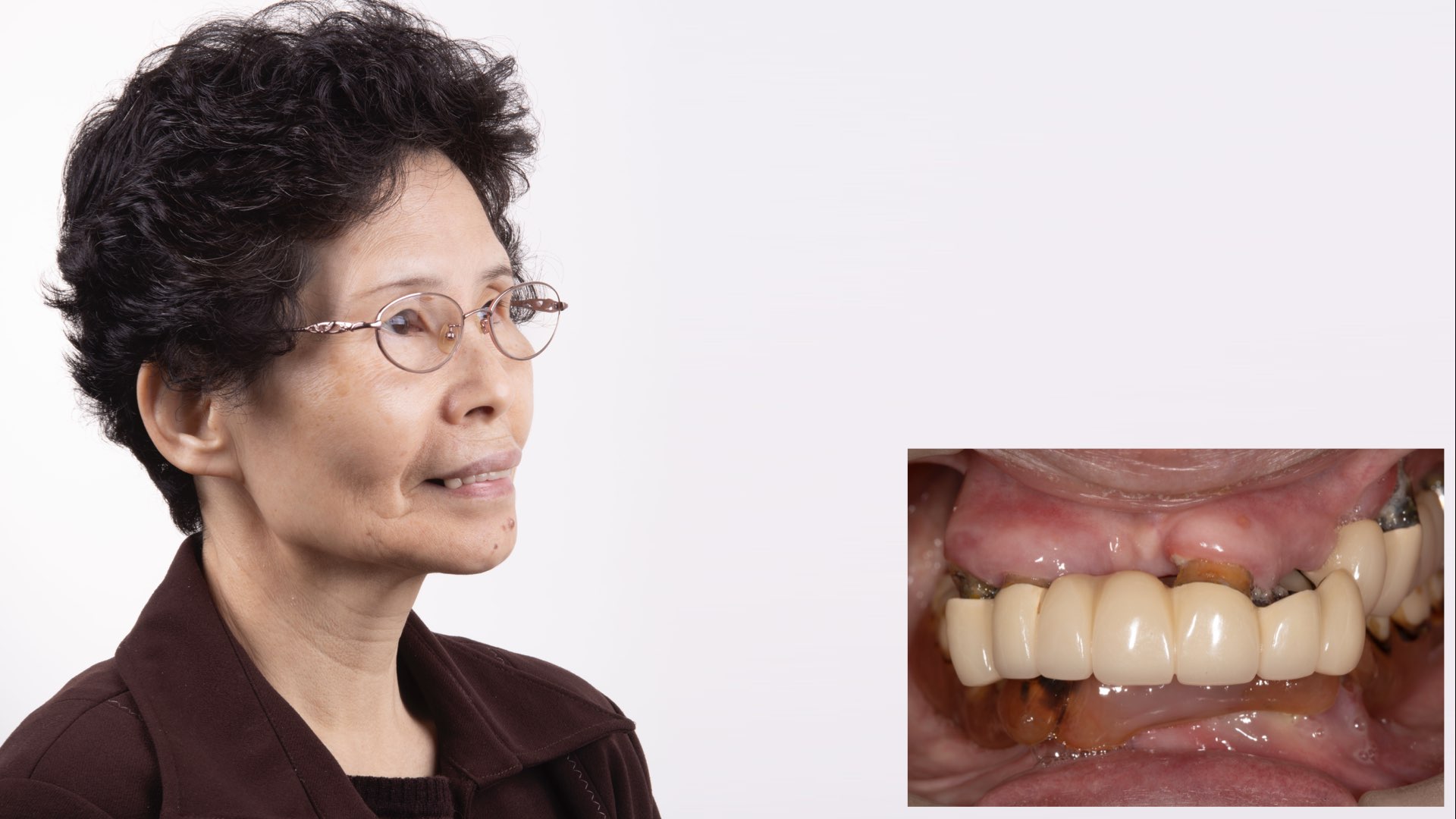 舊義齒下牙根狀況不好