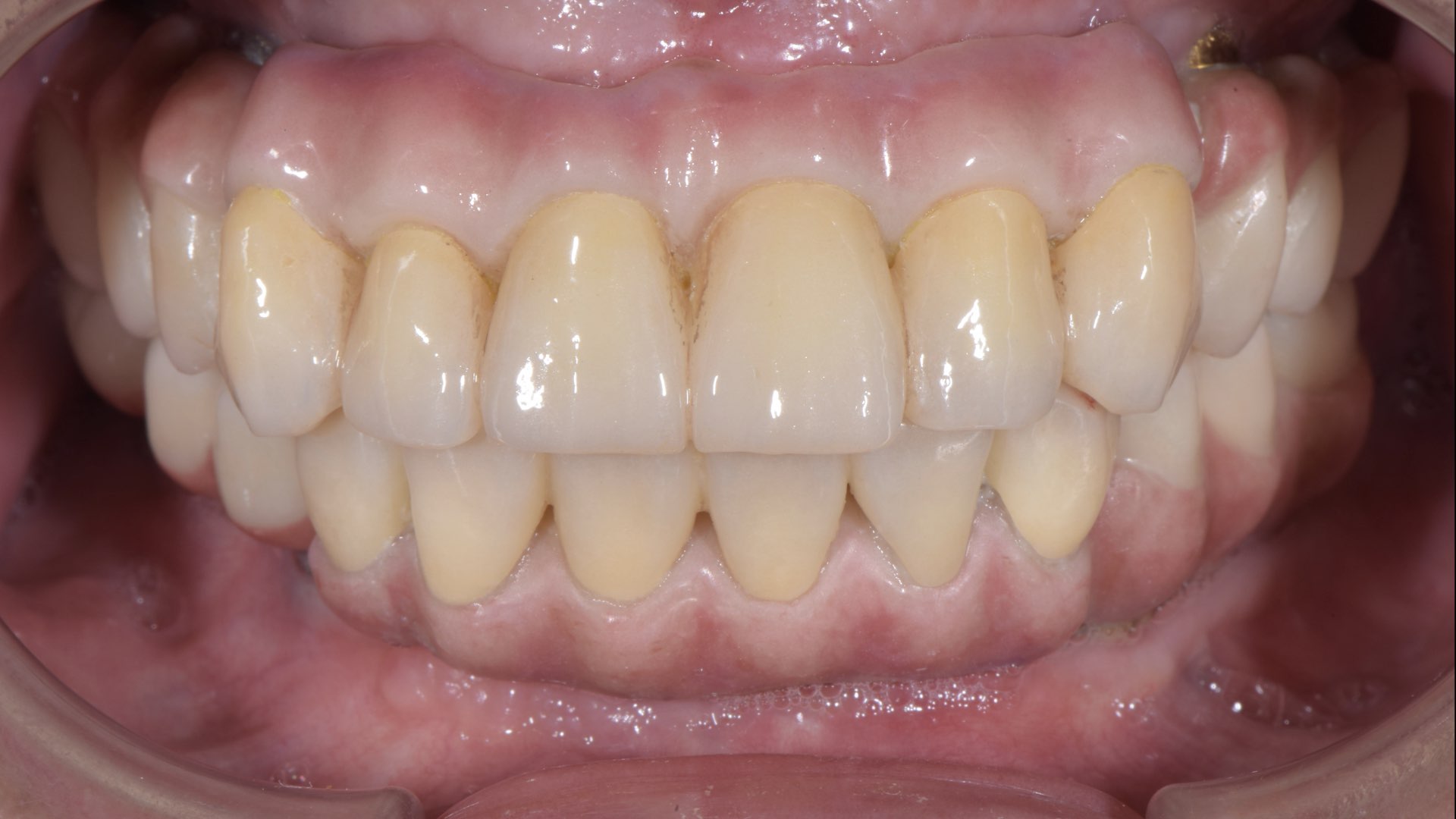 全口植牙固定義齒