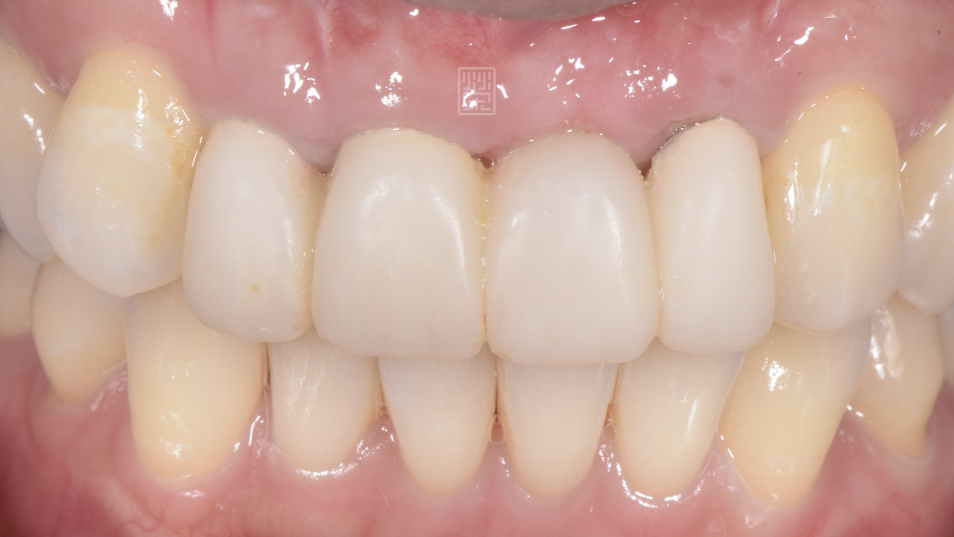 牙齦癒合且塑形完成