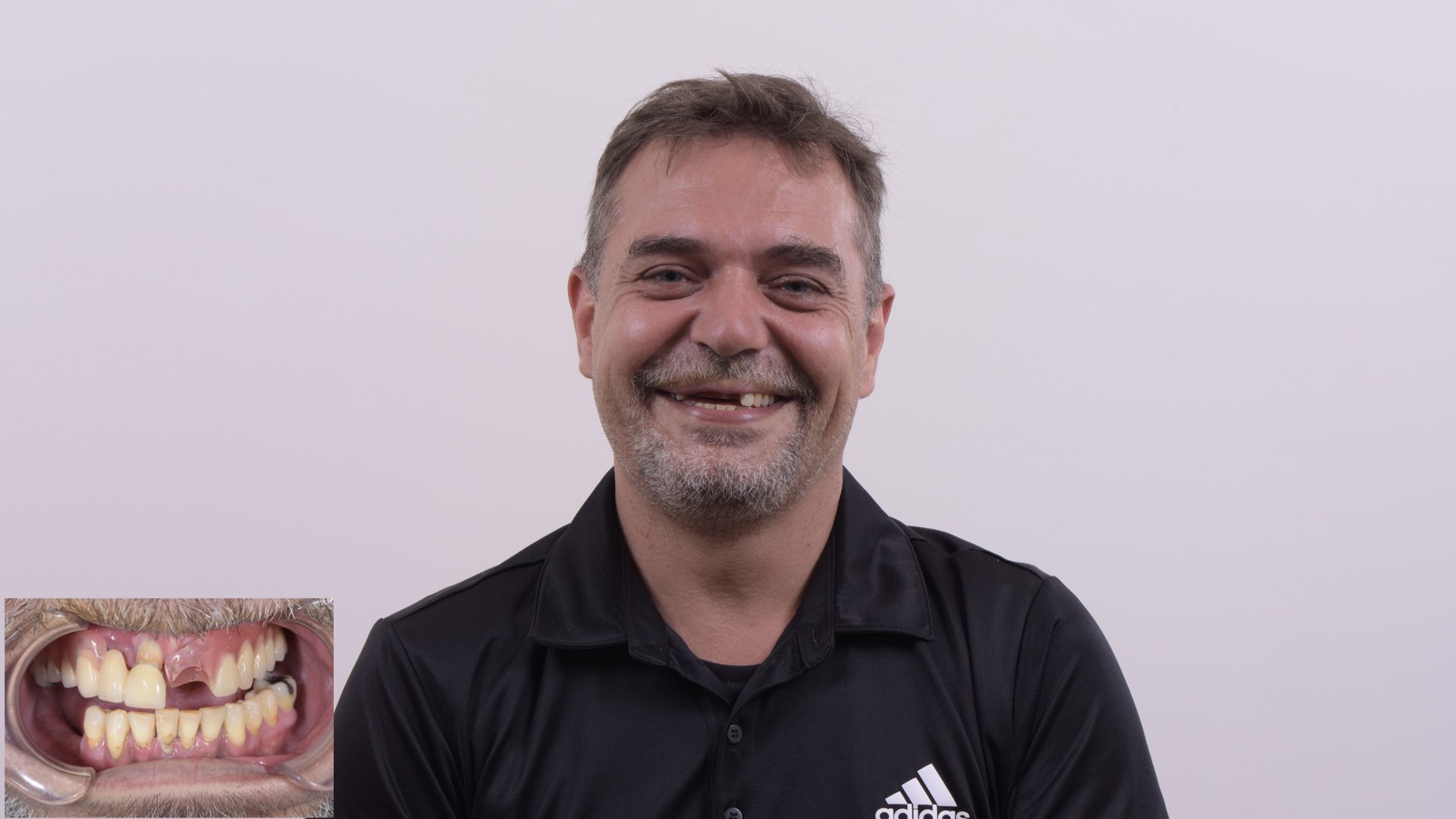 活動義齒不穩定