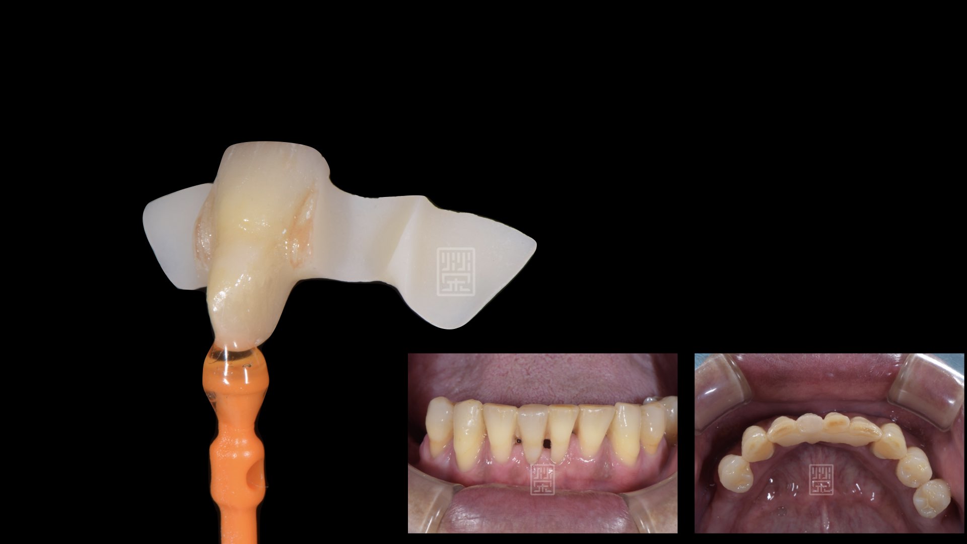 Maryland bridge(黏貼式固定義齒）