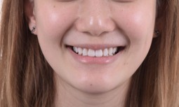 矯正後，覺得牙齒黃黃的————全瓷貼片