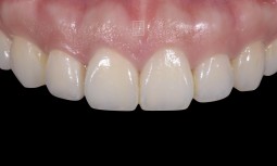 矯正後完美笑容的最後一哩路————全瓷冠治療